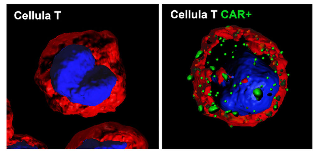 Arriva in Europa la Car-T, la prima terapia personalizzata contro il cancro